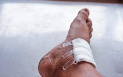 How to Treat a Chronic Wound?