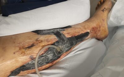 What is Wound Vac?