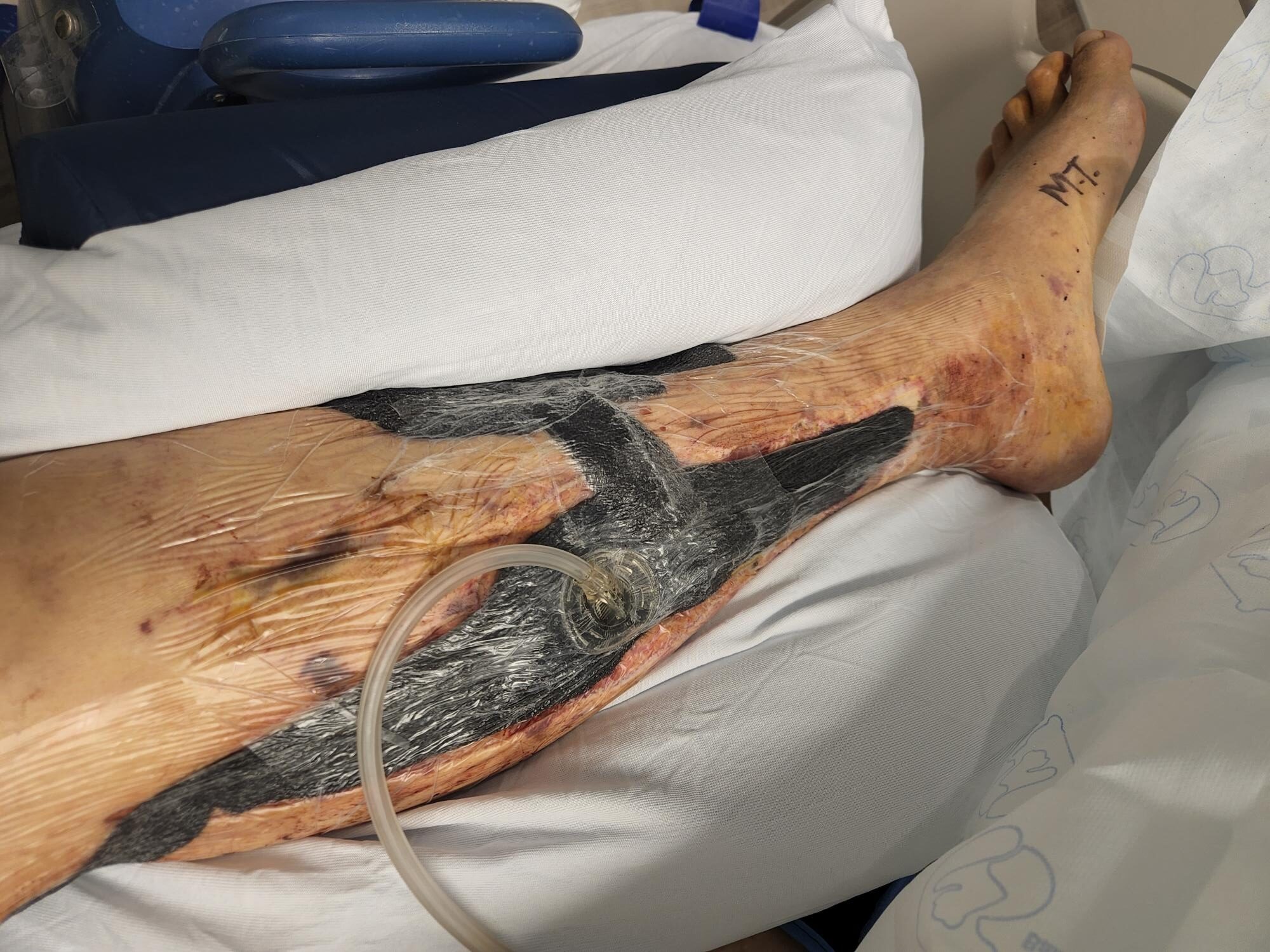 what-is-wound-vac-negative-pressure-wound-therapy wound vac