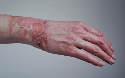 What Are Burn Blister Healing Stages?