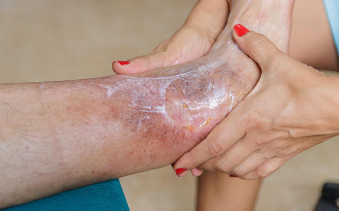 Diabetic Foot Ulcer (DFU) “Limb Salvage” at Home